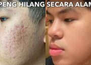 Cara Mencegah Jerawat Secara Alami dengan Efektif