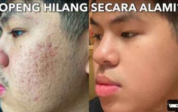Cara Mencegah Jerawat Secara Alami dengan Efektif