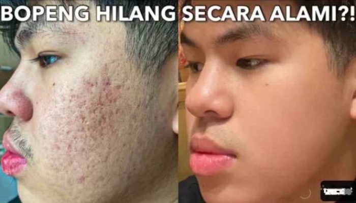 Cara Mencegah Jerawat Secara Alami dengan Efektif