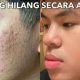 Cara Mencegah Jerawat Secara Alami dengan Efektif