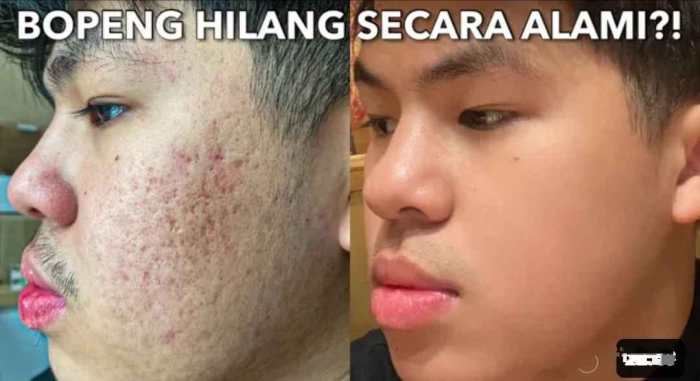 Cara Mencegah Jerawat Secara Alami