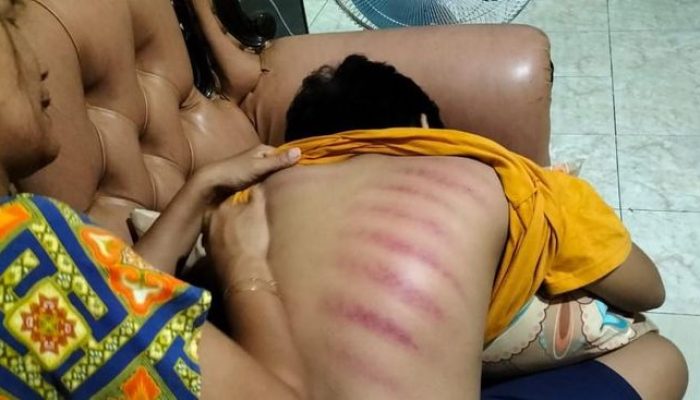 Kerokan Picu 8 Efek Berbahaya Selain Iritasi Kulit yang Harus Diketahui